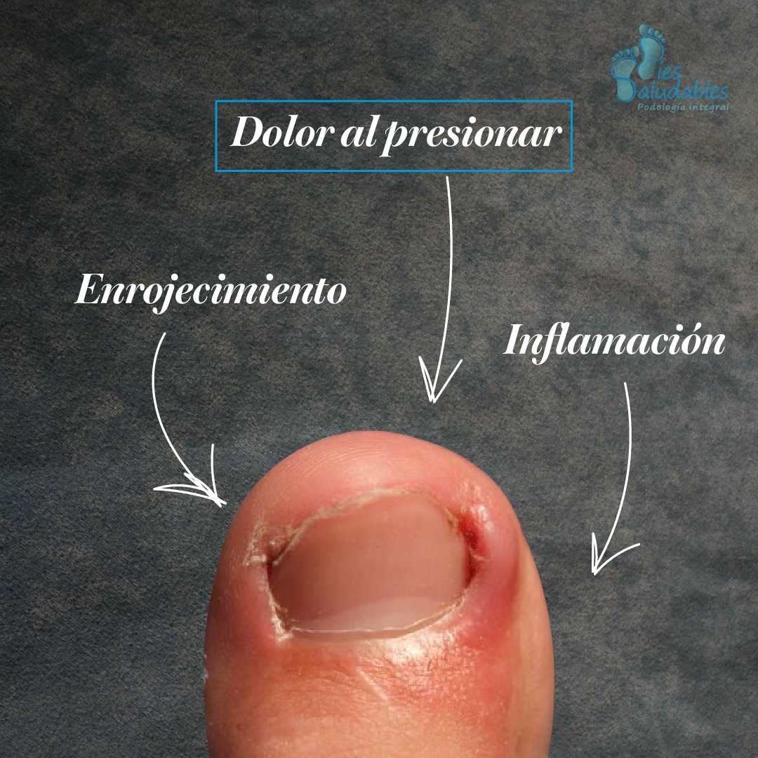 Síntomas de uña encarnada: dolor, enrojecimiento e inflamación